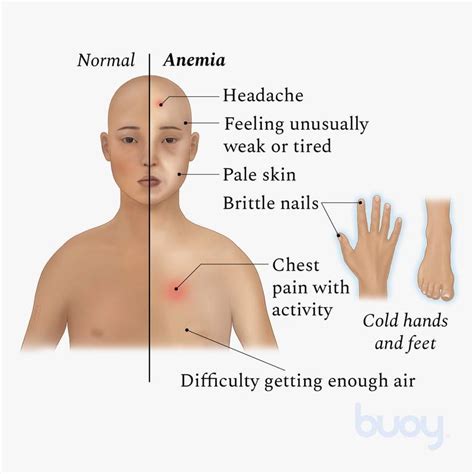 Iron Deficiency Anemia Symptoms