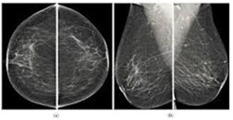 BILATERAL MAMMOGRAPHY – ScanLab Center