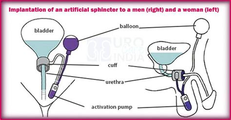 Pin on UroCareINDIA