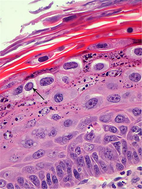 Histological characteristics of canine oral viral papilloma:... | Download Scientific Diagram