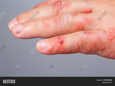 Shingles, Zoster Image & Photo (Free Trial) | Bigstock