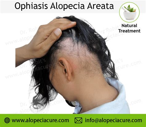 Ophiasis Alopecia Areata