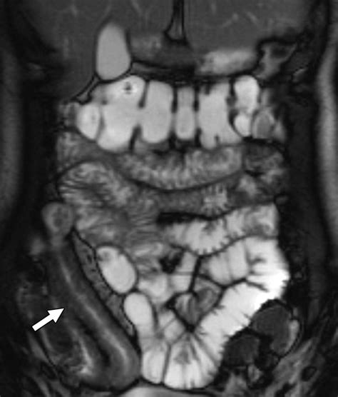 MRI Small-Bowel Follow-Through: Prone Versus Supine Patient Positioning ...