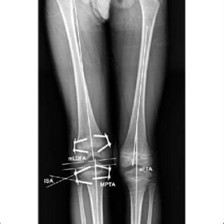 Preoperative X-ray of a male patient with 29 mm leg length discrepancy ...