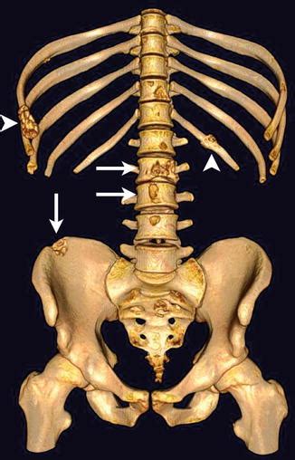 Bone Metastasis | Radiology Key