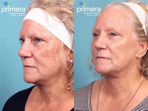 Chemical Peel Before and After Pictures Case 521 | Orlando, Florida | Primera Plastic Surgery