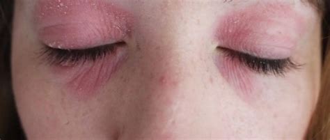 This Miracle Cream Got Rid Of My Eye Eczema [with Photos]