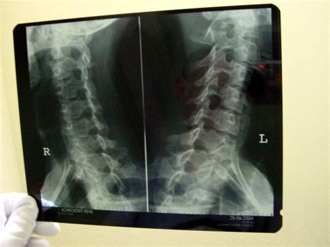 Cervical Spondylosis