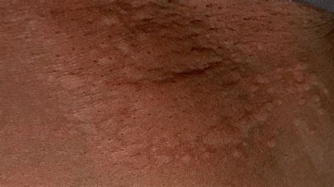 Hiv Rash On Chest Black People