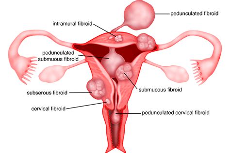 Bab 2 – Fibroid Rahim – Melaka Fertility – Selva’s Fertility, Obstetrics and Gynaecology Clinic