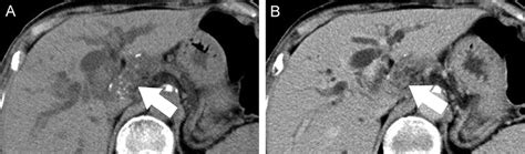 Dynamic-enhanced computed tomography (CT) scan at the level of porta ...