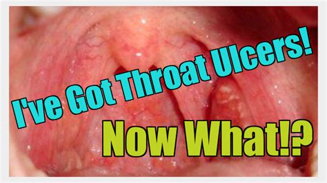 I Have Throat Ulcers! Now What!? - Roy on Rescue