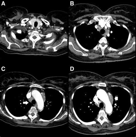 Mediastinal Lymph Nodes Ct Scan