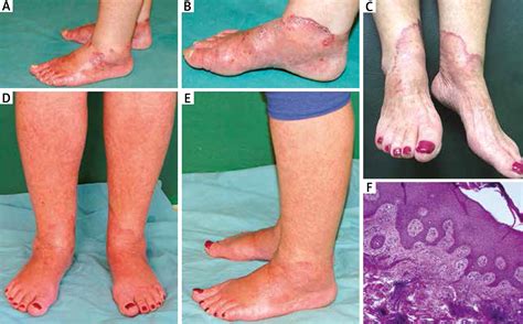 Symmetric acral annular erythema: a variant of erythema annulare ...