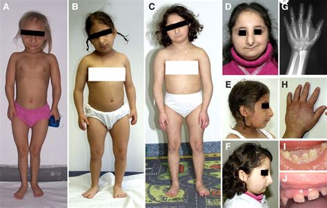 Primordial Dwarfism Mopd Type 1