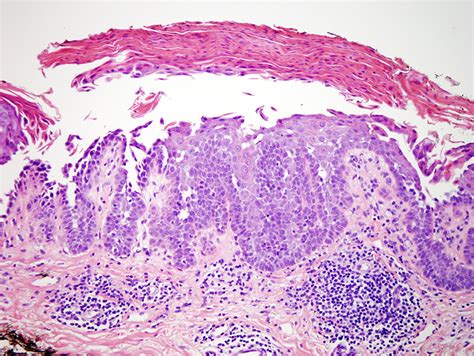 Acantholytic Acanthoma | Dermatopathology