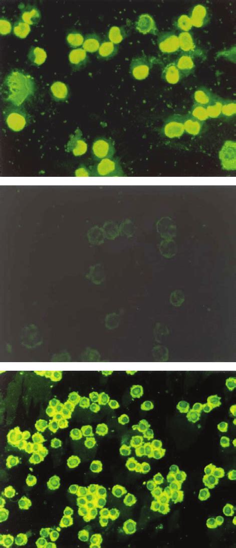 The staining patterns of antineuronal antibodies (anti-N) and ...