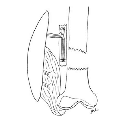 Positioning of the vascularized bone graft in relation to the femur on... | Download Scientific ...