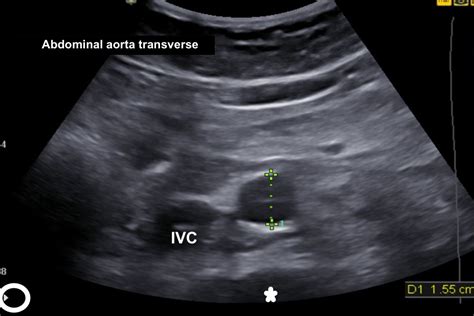 AAA screening: ultrasound image quality guidance - GOV.UK