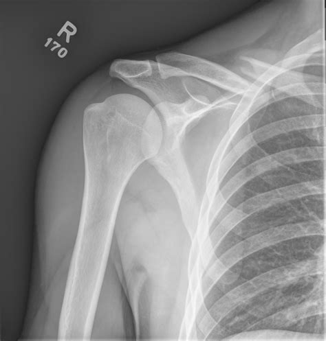 Clavicle Fractures – Core EM