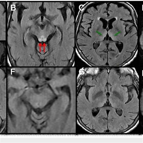 (PDF) Wernicke’s Encephalopathy