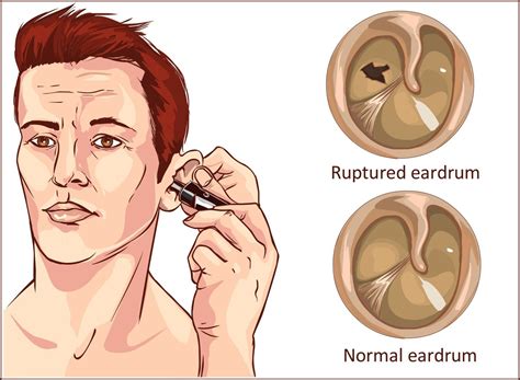 Why Do Your Ears Hurt After Running? All You Need To Know!