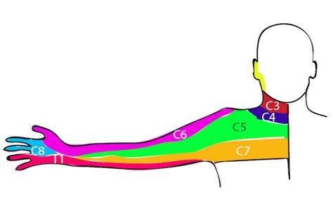 Radiculopathy Dermatomes