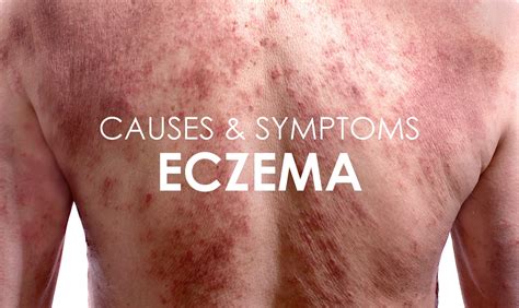 Eczema: Causes, Symptoms & Treatments - Premier Clinic