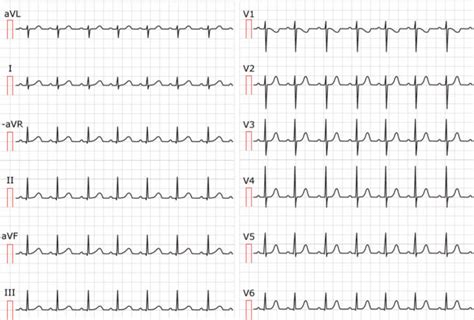 Sinus tachycardia & Inappropriate sinus tachycardia – Cardiovascular ...