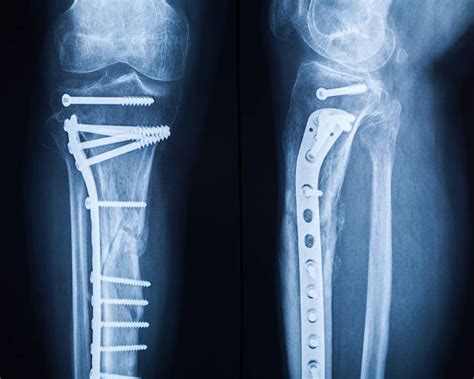 Best Broken Leg Xray Stock Photos, Pictures & Royalty-Free Images - iStock