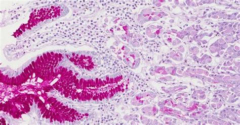 Pas Stain (Periodic acid–Schiff stain) | eMedicalHelp