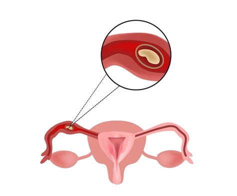 What Is Ectopic Pregnancy? Tubal Pregnancy | familydoctor.org