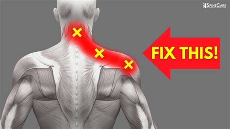 How to instantly fix pinched nerve pain in the neck and shoulders – Artofit