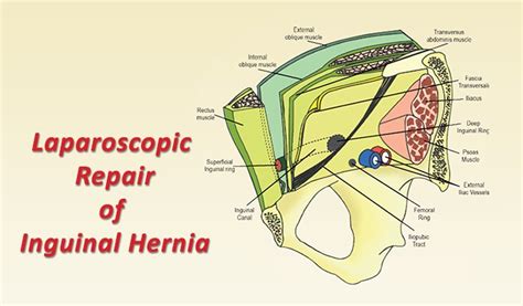 Laparoscopic Repair of Inguinal Hernia | Healthcare