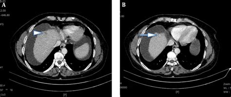 CT Scan of Liver Reveals (A) a Small Linear Subcapsular Hypodense ...