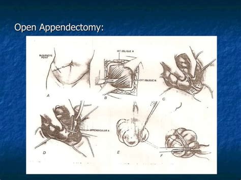 Appendix, Surgery