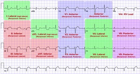 ECG Lead Placement - Cardio Guide