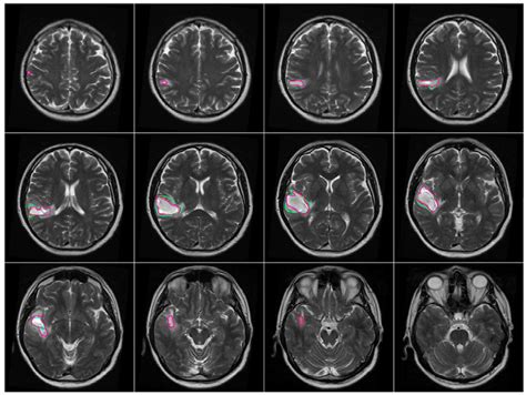 Symmetry | Free Full-Text | Segmentation of Brain Tumors in MRI Images Using Three-Dimensional ...