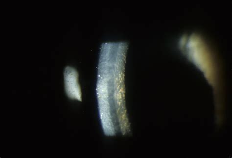 Corneal Dystrophy, Fuchs Endothelial, Late Onset | Hereditary Ocular Diseases