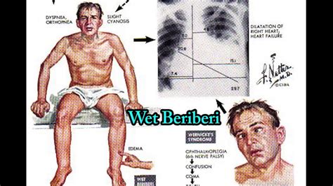 Thiamine Deficiency, Beriberi. Dry Beriberi VS Wet Beriberi - YouTube