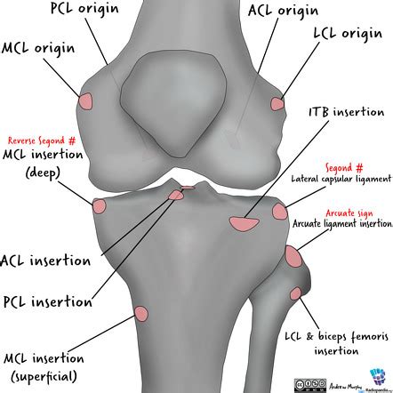 Avulsion Fracture Knee