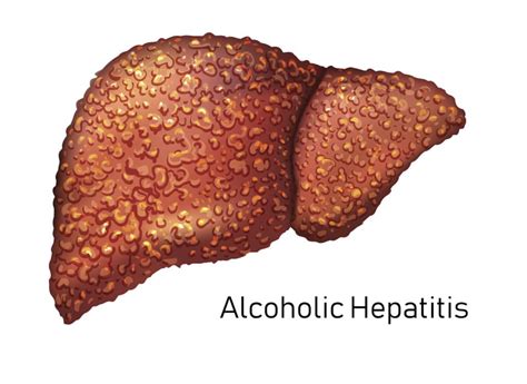 Alcoholic Hepatitis Liver