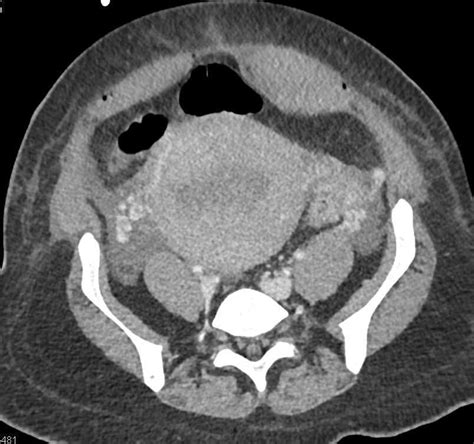 Post Partum Complications Including Pancreatitis and SBO / CTisus.com | Small bowel obstruction ...