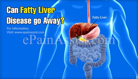 Fatty Liver (Hepatic Steatosis): Signs, Symptoms and How to Prevent It ...