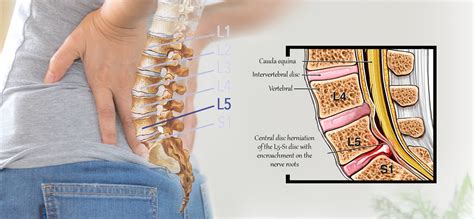 L5-S1 Disc Bulge, Slip Disc, Stenosis & Spondylolisthesis