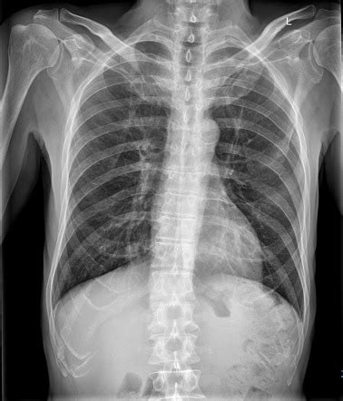 Chest X-ray Fracture Right Posterior 6th Rib And Possible, 45% OFF