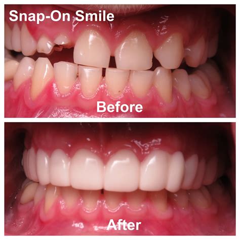 Snap-On Smile® – Caring Family Dentistry