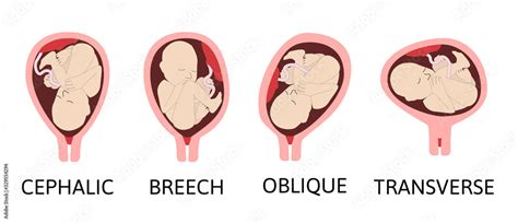 Different baby positions during pregnancy. Cephalic, Breech, transverse, Oblique lies. Colored ...