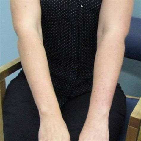 Subtle arm swelling and discoloration associated with subclavian ...