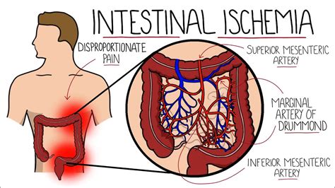 Intestinal Ischemia - Mesenteric Ischemia (Acute & Chronic) & Ischemic ...